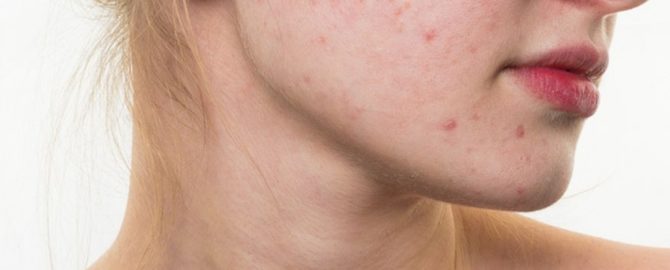 acne-vulgaris-848x518