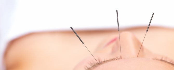 acupuncture-for-weight-loss-cost-2